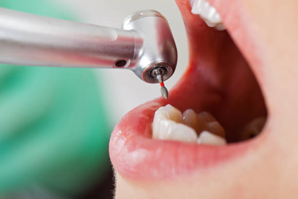 Best Emergency Gum Treatment in Bass Lake, IN